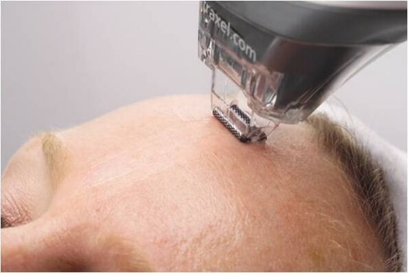 Procedura di peeling per ringiovanire la pelle del viso